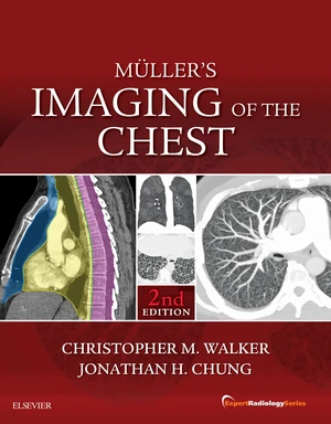 Muller's Imaging of the Chest E-Book