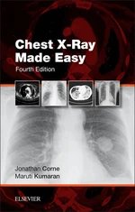 Chest X-Ray Made Easy E-Book