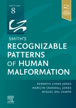 Smith's Recognizable Patterns of Human Malformation - E-Book