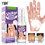 1pcs 30ml Vitiligo Cream White Spot Repair Spray Antibacterial Cream Pigment Melanin Promoting Skin Vitiligo Treatment Plaster